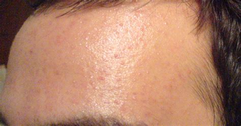 Pimples Only On Forehead Adult Acne Forums