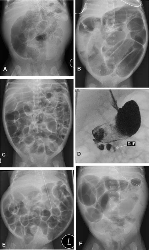 Plain Abdominal Radiographs And An Upper Gastrointestinal Contrast