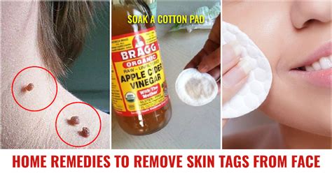8 Home Remedies To Remove Skin Tags From Face