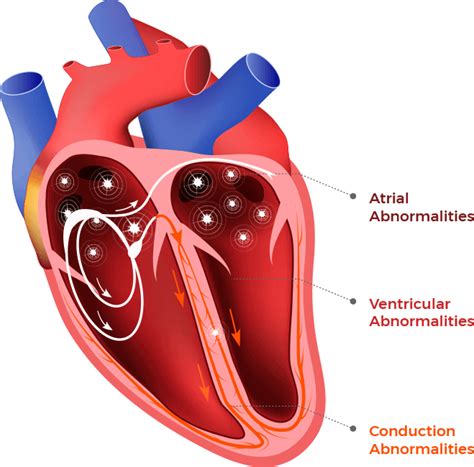 Dysrhythmia And Are Used To Describe Abnormal Heart Rhythm