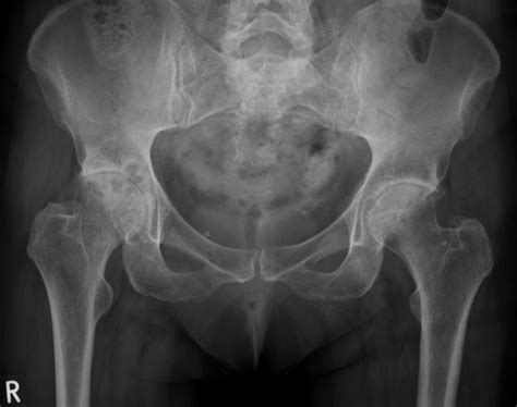 Anteroposterior Radiograph Of The Pelvis Showing Right Hip
