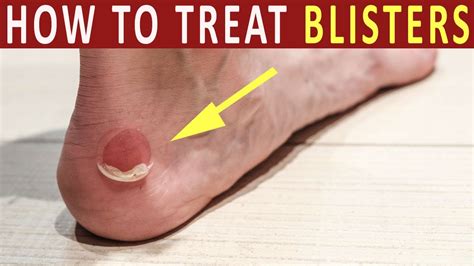 how to treat blisters home remedies of blister treatment and heal youtube