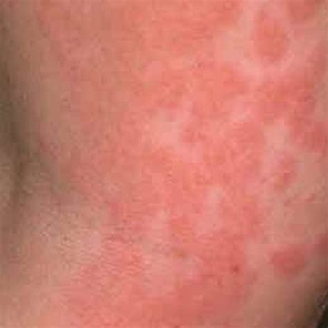 How To Treat Rashes From The Side Effects Of Lactobacillus Ehow