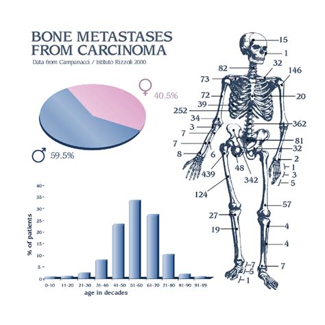 Metastatic Bone Disease Bone And Spine
