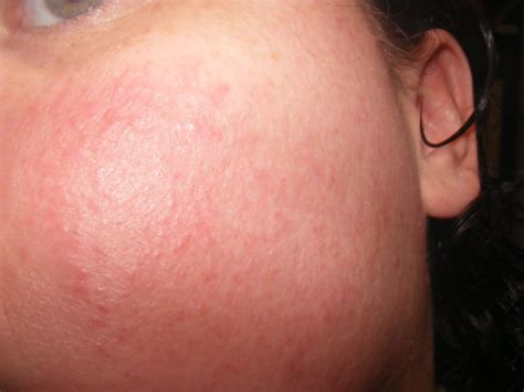 Keratosis Pilaris On The Face Dorothee Padraig South West Skin Health