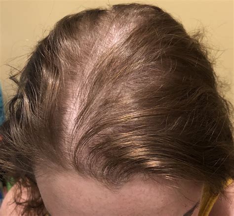 Women's hairpieces are a fun and effective way to resolve hair loss in orlando, fl.with the option to permanently adhere your hairpieces, or adhere them temporarily, you no longer have to worry about covering up your hair loss on a daily basis! Women's Hair Loss Treatment Solutions in NJ — Mancuso ...