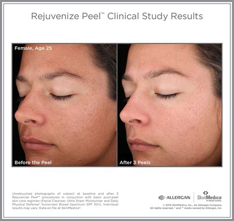 Rejuvenize Chemical Peel Advamced Dermatology Of The Midlands