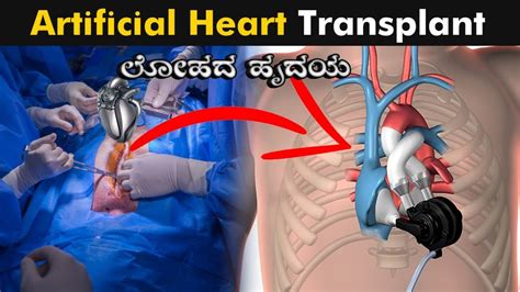 Total Artificial Heart Inplantation Permanent Artificial Hearts Are
