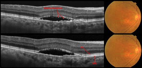 Dots Spots And Other White Retinal Lesions Page 48 Of 61 Retina