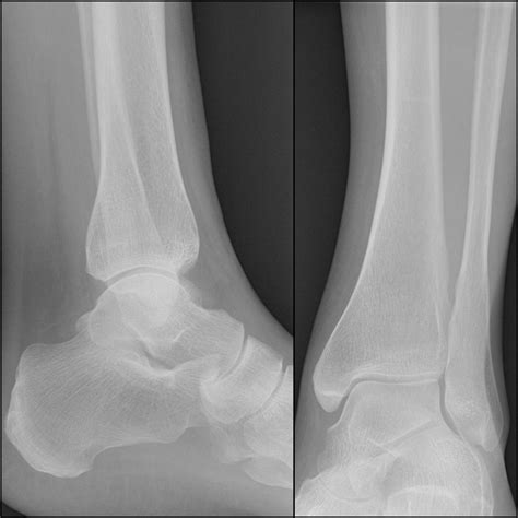 Normal Left Ankle Xray