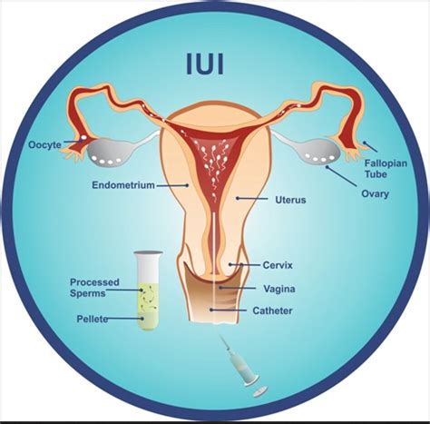 What Is IUI How Does It Work Success Rate Cost Details