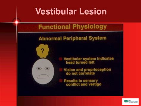 Ppt Vestibular Disorders Powerpoint Presentation Free Download Id