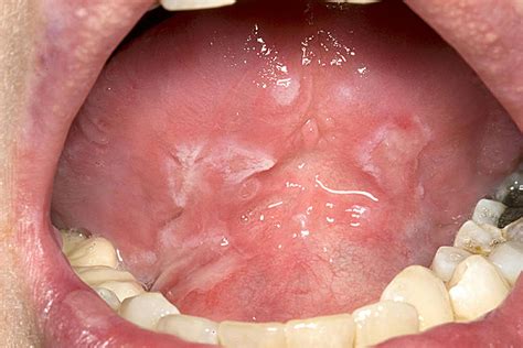 Erythema Multiforme Lips Herpes