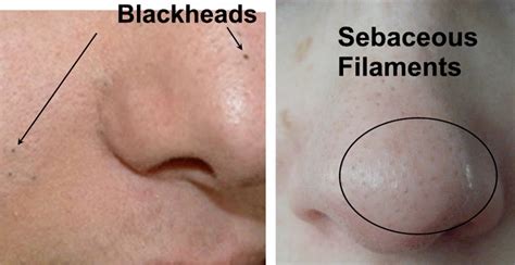 The Truth About Blackheads How To Actually Get Rid Of Them