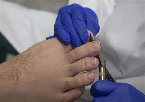 How To Prevent And Treat Ingrown Toenails Feet First Clinic