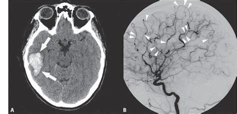 Figure 1 From Middle Cerebral Artery Dissection Gives Rise To Giant
