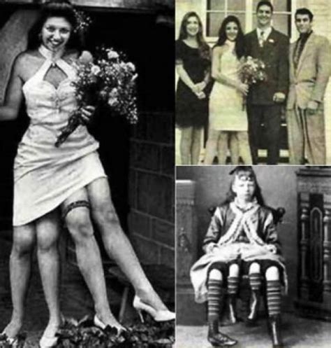 Conheça A História De Myrtle Corbin A Mulher De Quatro Pernas