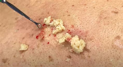 Sebaceous Cyst New Pimple Popping Videos