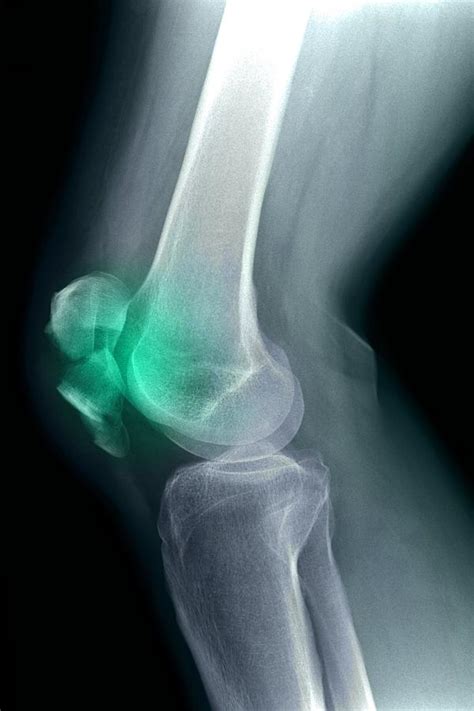 Kneecap Fracture X Ray Photograph By Du Cane Medical Imaging Ltd