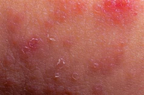Invaluable Eczema Advice That Will Give You The Help You Want Atopic