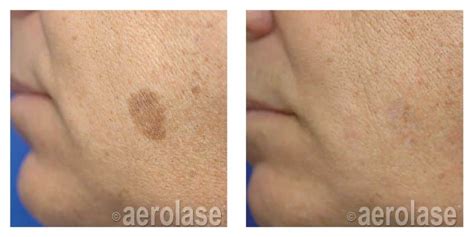 Laser Treatments Ageless Skin Rejuvenation In Virginia Beach