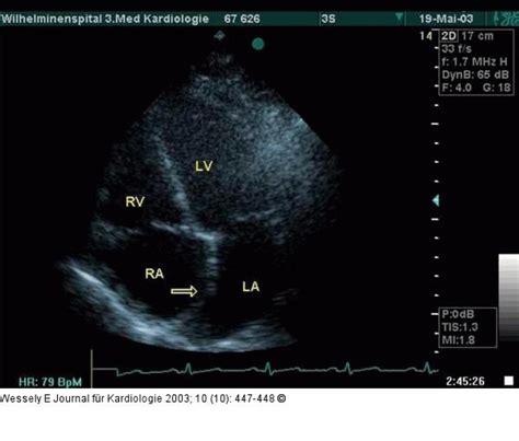 Pericarditis (pc) is an inflammation that affects the pericardium, consisting of two leaves, visceral and parietal. Abbildung 2: Pericarditis constrictiva