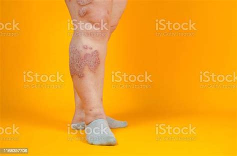 Dermatological Skin Disease Psoriasis Eczema Dermatitis Allergies Skin