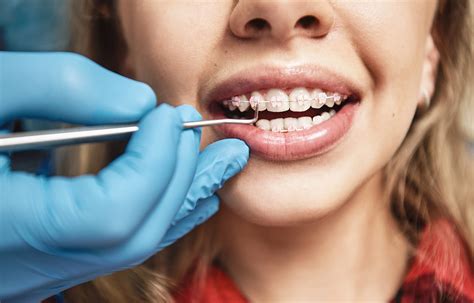 What Is The Process Of Getting Braces Put On Tisseront Orthodontics