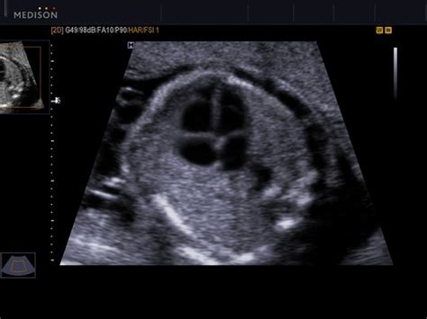 Ultrasound Images Fetal Heart 4 Chamber View B Mode Echogramm №521
