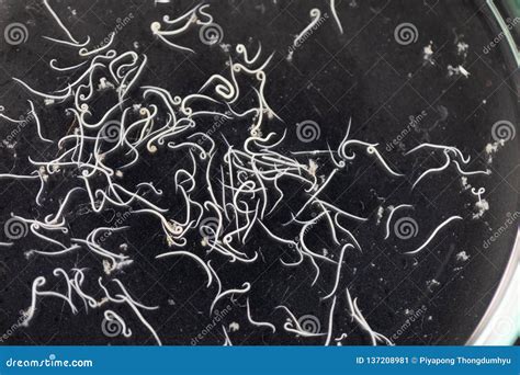 Ascariasis Is A Disease Caused By The Parasitic Roundworm Ascaris