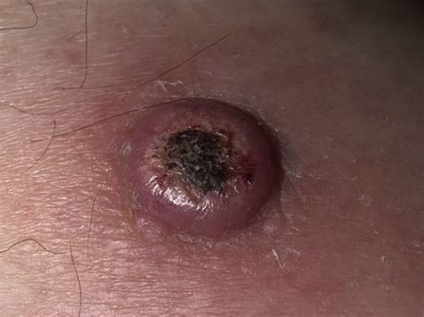 Keratoacanthoma Squamous Cell Carcinoma Pictures Photos