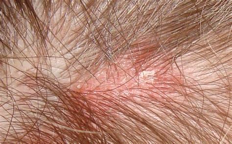 Red Splotches On Scalp Pictures Photos
