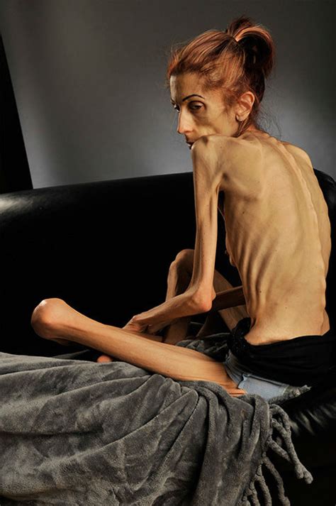 Photos California Woman Rachael Farokh Describes Her Shocking Descent Into Anorexia Abc Chicago
