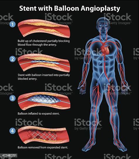 Stent Angioplastie Verfahren Stock Vektor Art Und Mehr Bilder Von