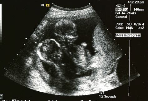 Smithback Twins 16 Week Ultrasound Pictures