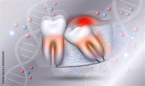 Wisdom Tooth Eruption Inflamed Gums Illustrated Anatomy On A Beautiful