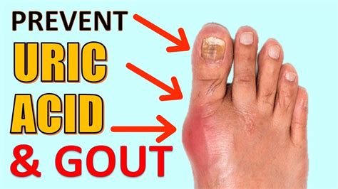 22 Natural Gout Treatments To Remove Uric Acid Crystalization To