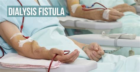 Dialysis Fistula For End Stage Renal Disease Medsynapse