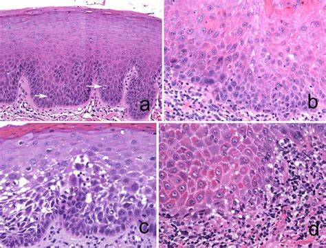 Oral Epithelial Dysplasia Atypical Verrucous Lesions And Oral