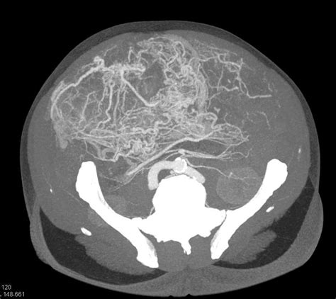 Large Abdominal Gist Tumor Gastrointestinal Case Studies Ctisus Ct