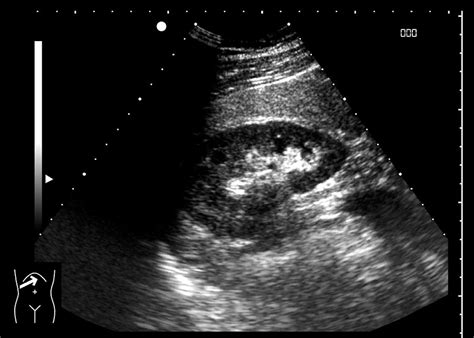 Healthy Kidney Ultrasound Scan Photograph By Miriam Maslo Pixels