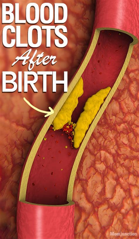 Blood Clots After Birth Causes Symptoms And Treatment Momjunction
