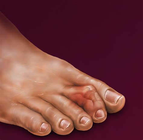 Current Concepts In Hammertoe Correction