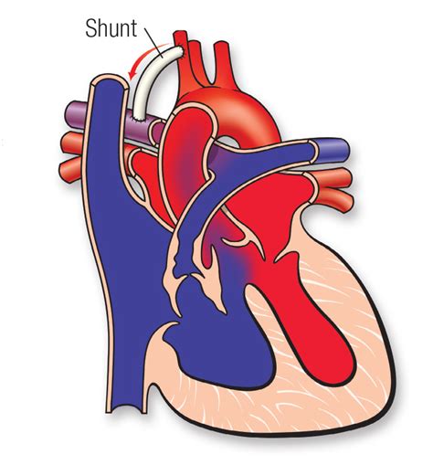 Tetralogy Of Fallot American Heart Association