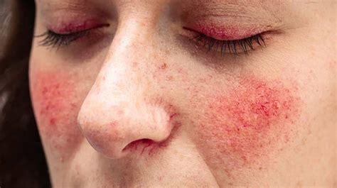 Face Redness Rosacea Types Stages Symptoms Causes And Prevention