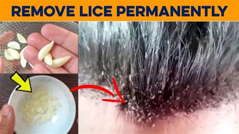 How To Get Rid Of Lice Permanently In 1 Hour Remove Lice Eggs From