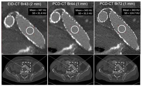 First Clinical Photon Counting Ct System Outperforms Current Ct Axis