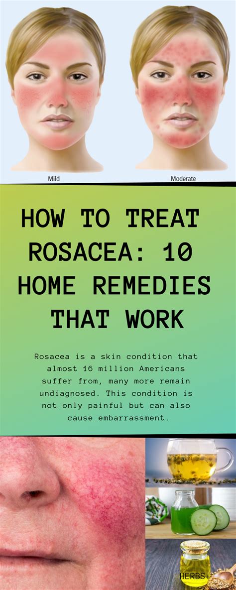 How To Treat Rosacea 10 Home Remedies That Work How To Treat Rosacea