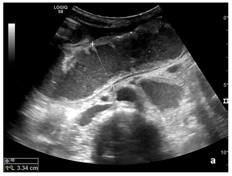 Diagnostics Free Full Text Ultrasound Of Small Bowel Obstruction A