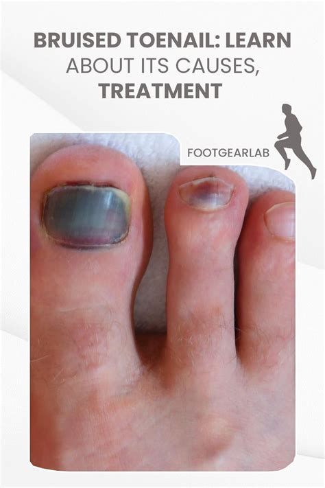 Bruised Toenail Learn About Its Causes Treatment And Prevention Artofit